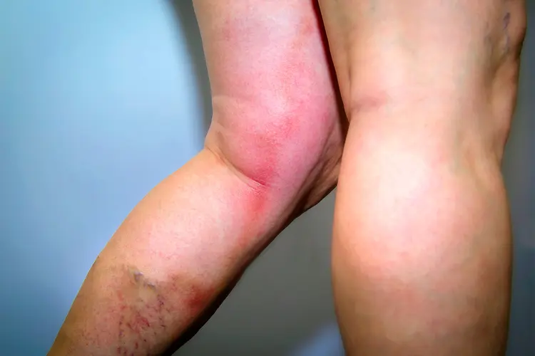 Deep Vein Thrombosis (DVT) Treatment: Medications, Procedures & Home Care
