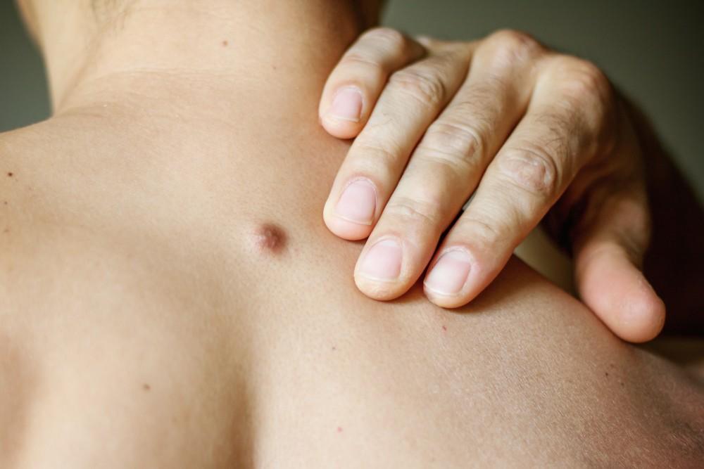 Are Skin Cysts Dangerous?: South Florida Surgical Group: General Surgery