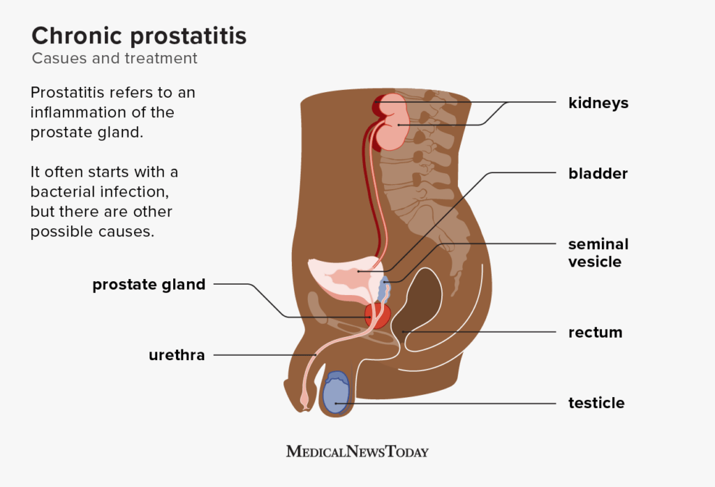 Chronic prostatitis: Causes, symptoms, diagnosis, and treatment