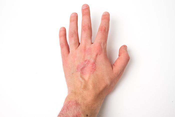 What's This Red, Scaly Patch on My Skin?: Trevan Fischer, MD: Surgical Oncologist