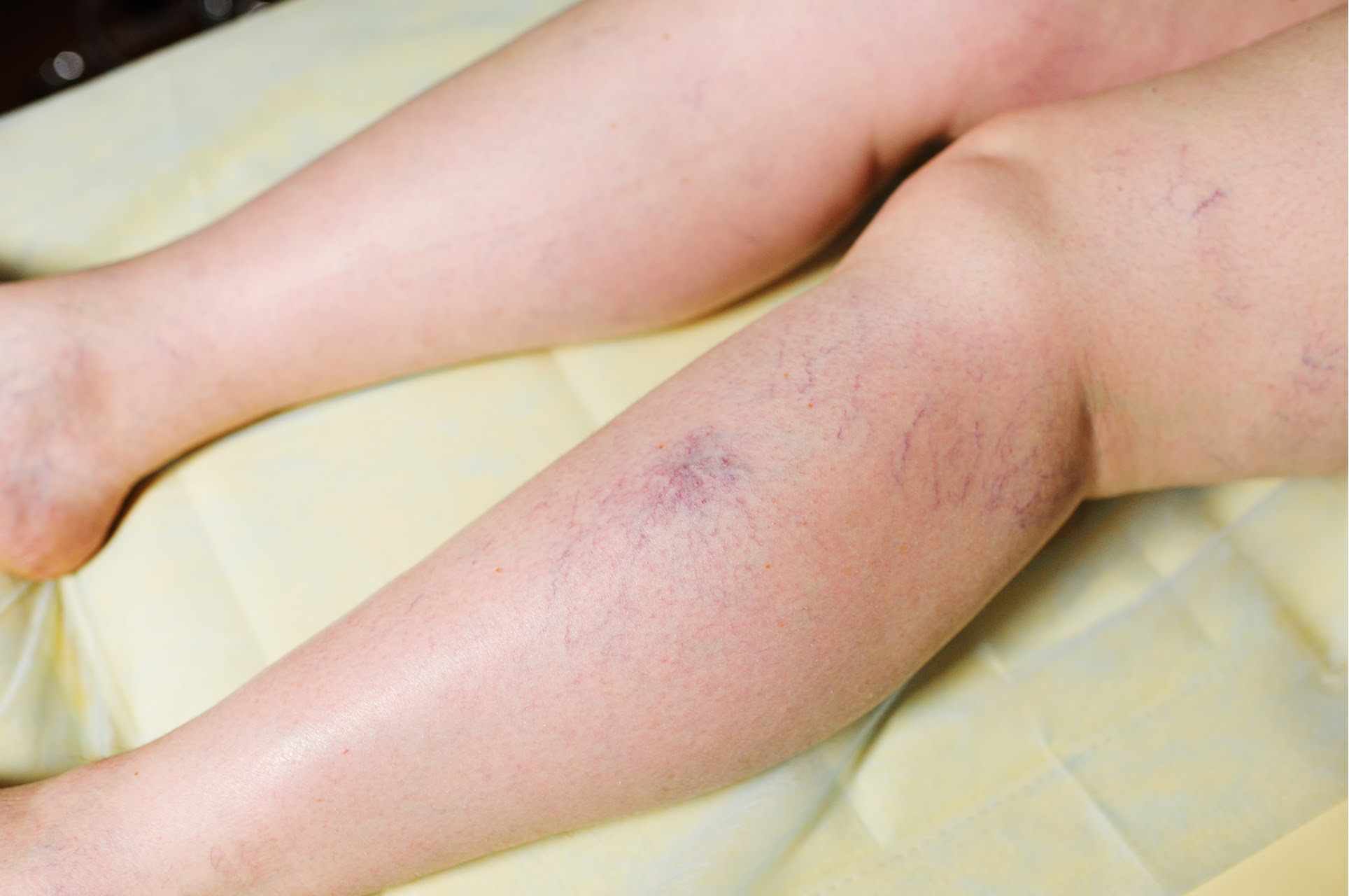 Is Cold Weather Among The Causes Of Thread Veins On Legs?