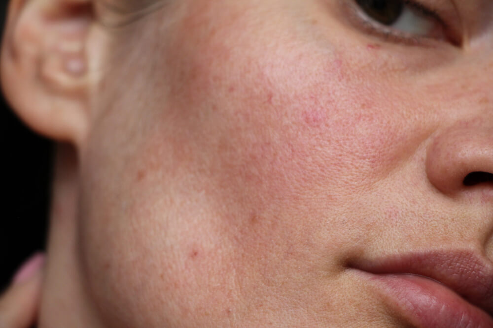 Prescription Dull Skin Treatment Subscription | MiQuest