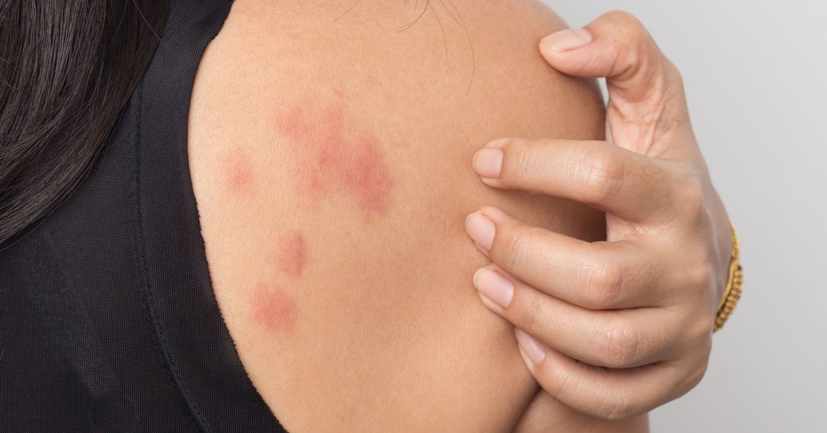 Stress Hives: Causes, Treatment, and More