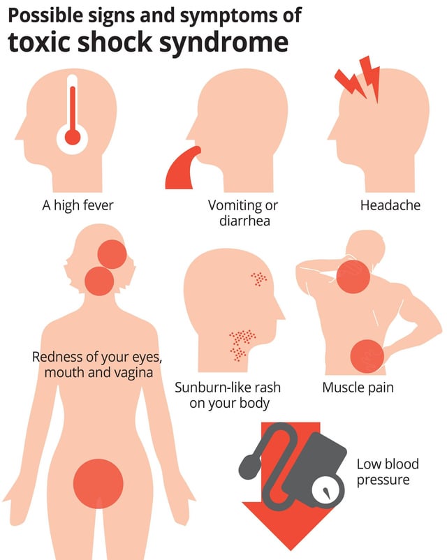Toxic shock syndrome symptoms : r/coolguides