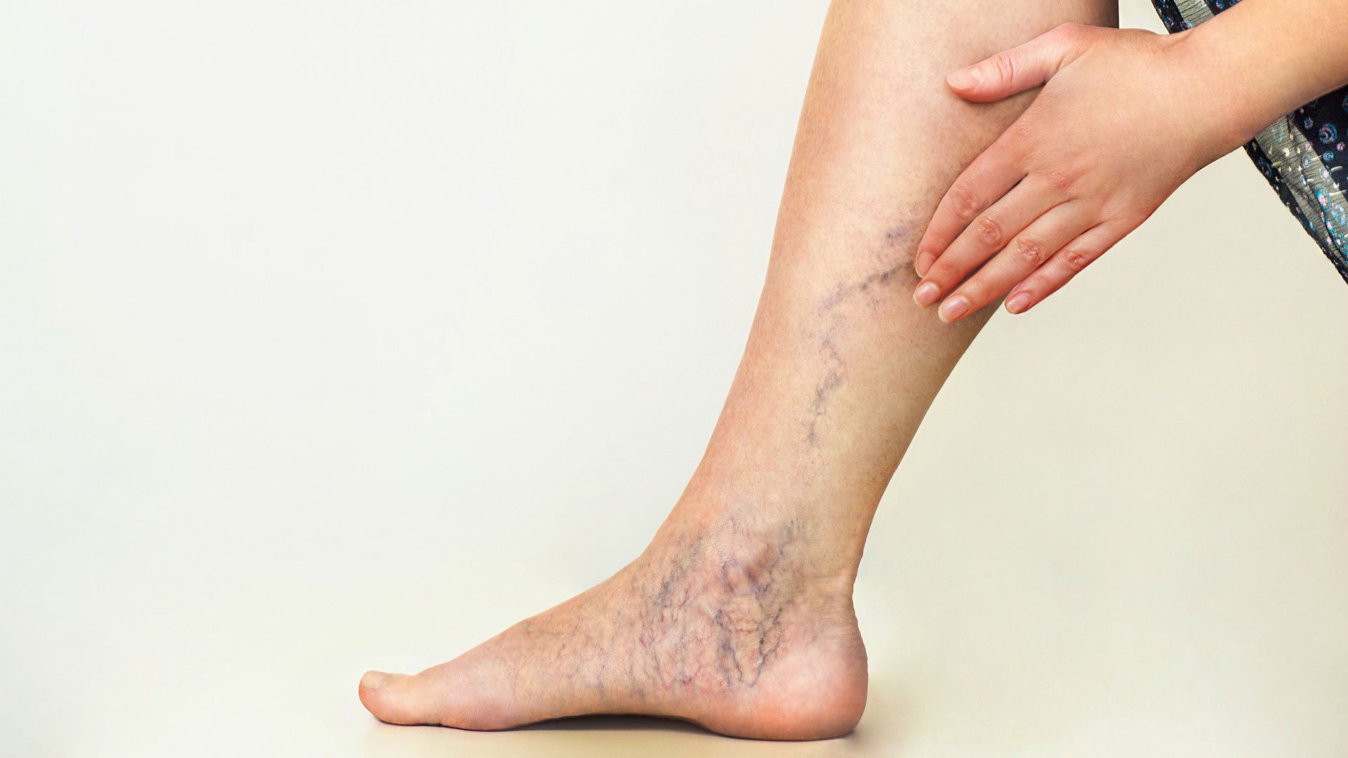 Summer Tips to Minimize Chronic Venous Insufficiency