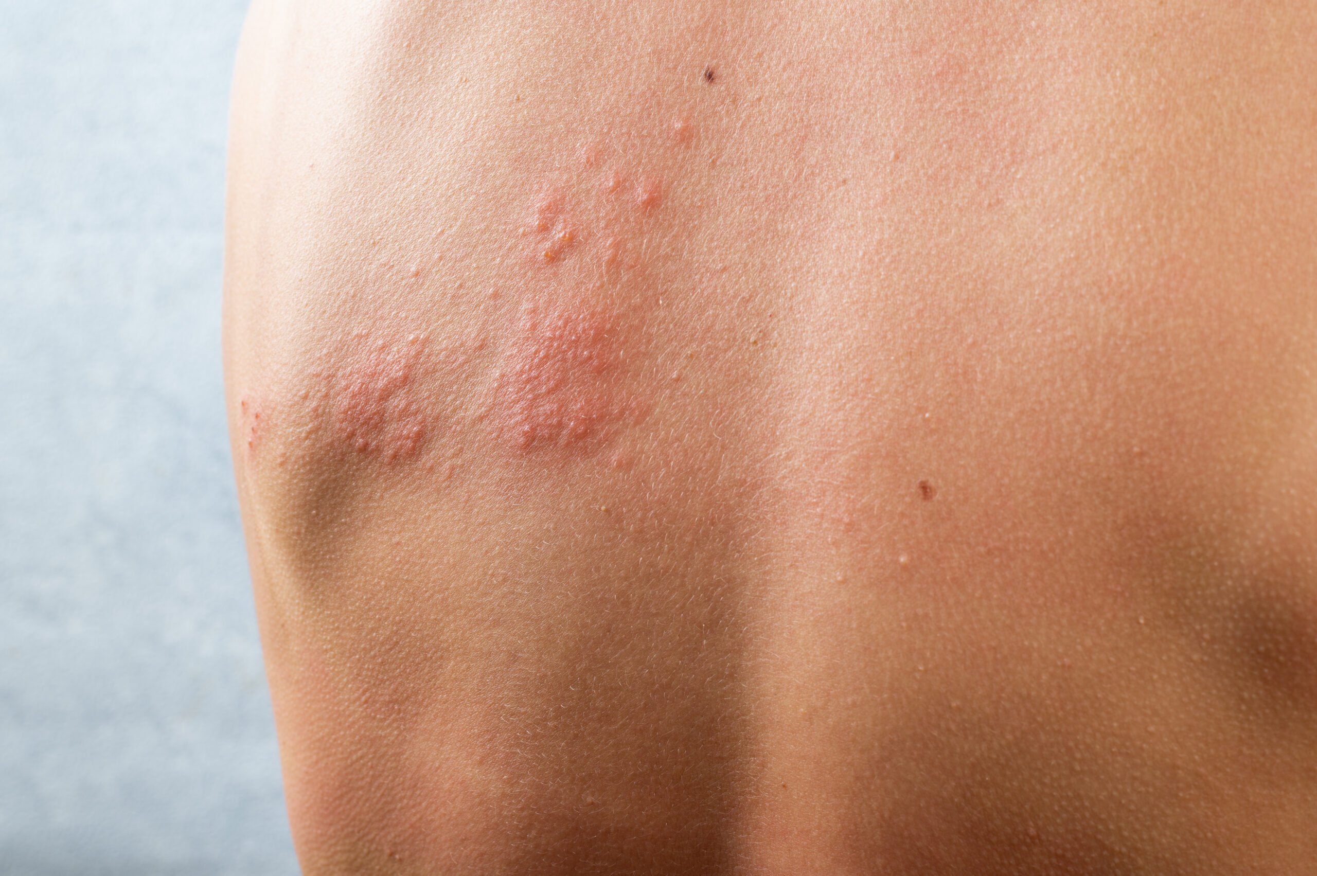 Contact Dermatitis - LA Dermatology | Dermatology