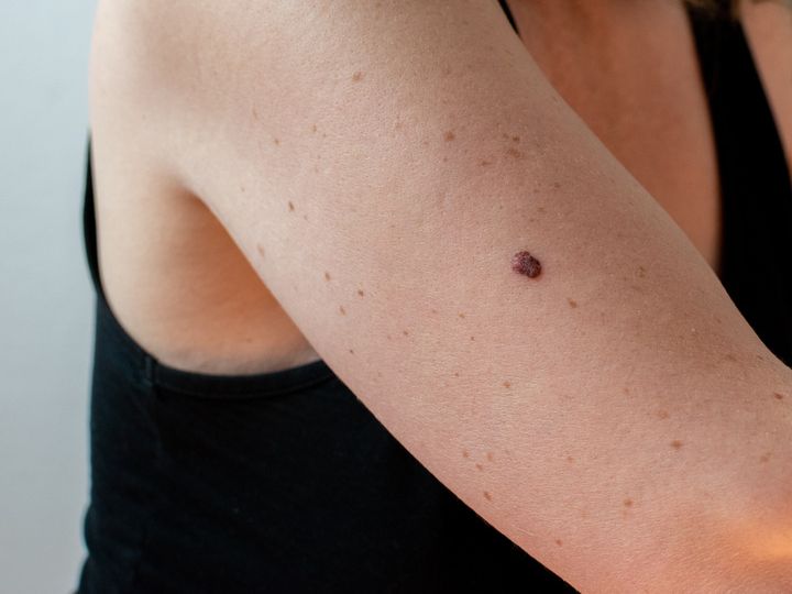 3 Types of Skin Cancer That Should Be on Everyone's Radar | SELF