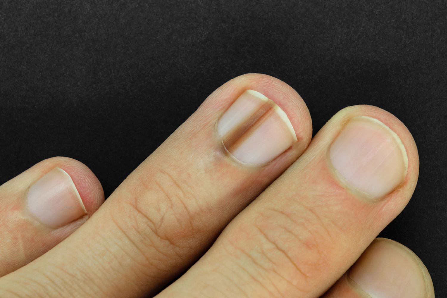Black Line on Nail: Causes and When to Worry