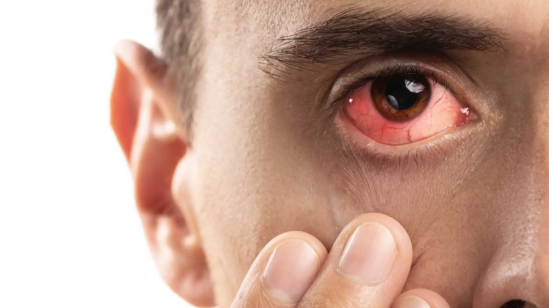 Is Your Eye Infected? 10 Key Signs to Watch For