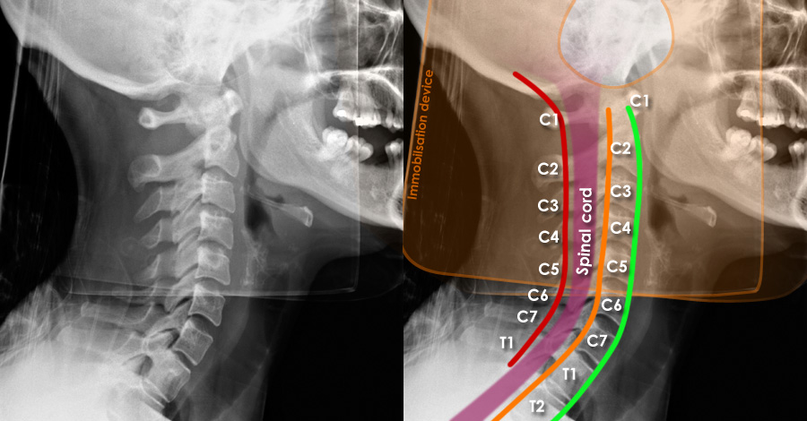 Trauma X-ray - Axial skeleton - Cervical spine - Normal anatomy