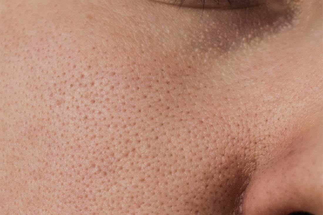What Causes Clogged Pores? Do You Have Congested Skin? – Love Wellness