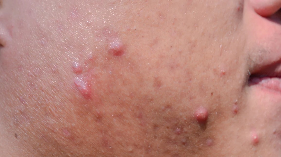 Cyst: Pictures, Causes, Types, Treatments, and Prevention