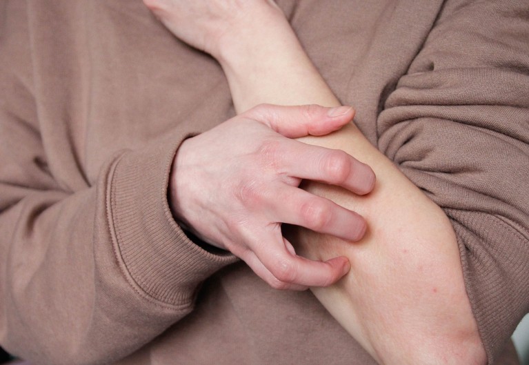 Why it feels good to scratch that itch: the immune benefits of scratching