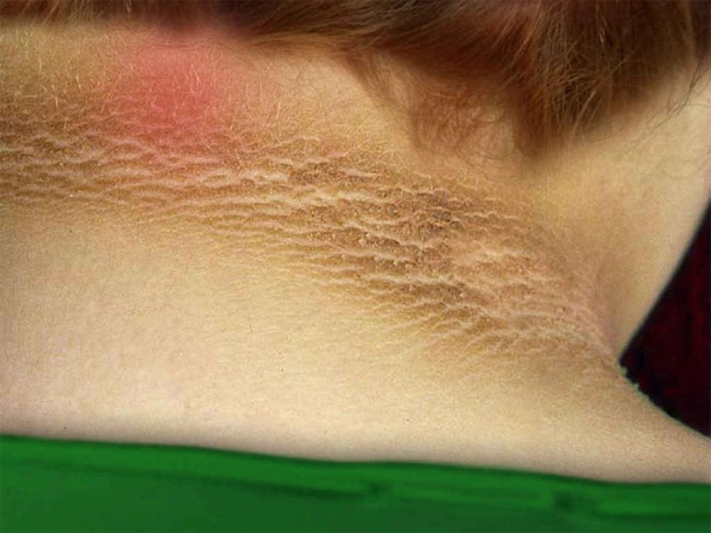 Acanthosis Nigricans Skin Pigmentation | Dermatology Houston, Spring TX | Katy