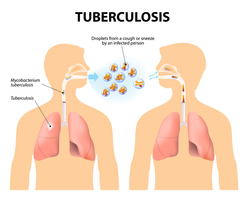 Tuberculosis - Harvard Health