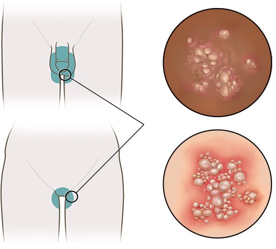 Genital herpes | informedhealth.org