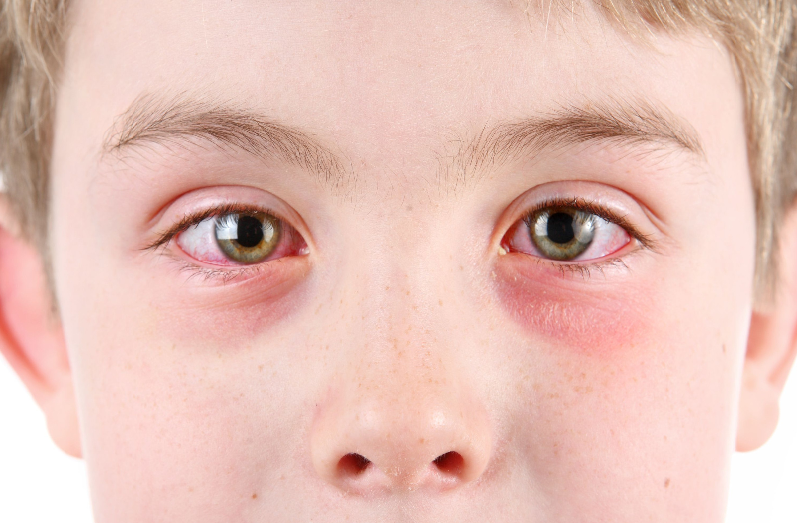 Eye Infections in Kids: Signs & Symptoms to Watch For - Total Vision Culver City