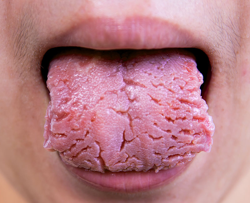 Fissured Tongue: Causes & Treatment