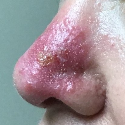 Skin Cancer on Nose | Cancer on Nose