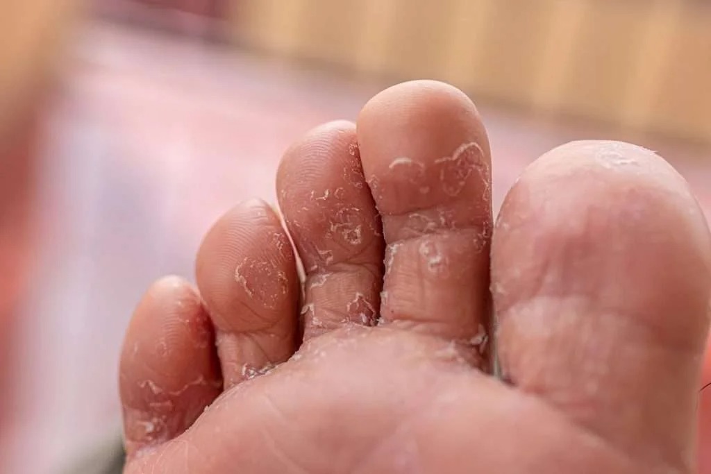 fungus-on-feet-1024x683-1-7