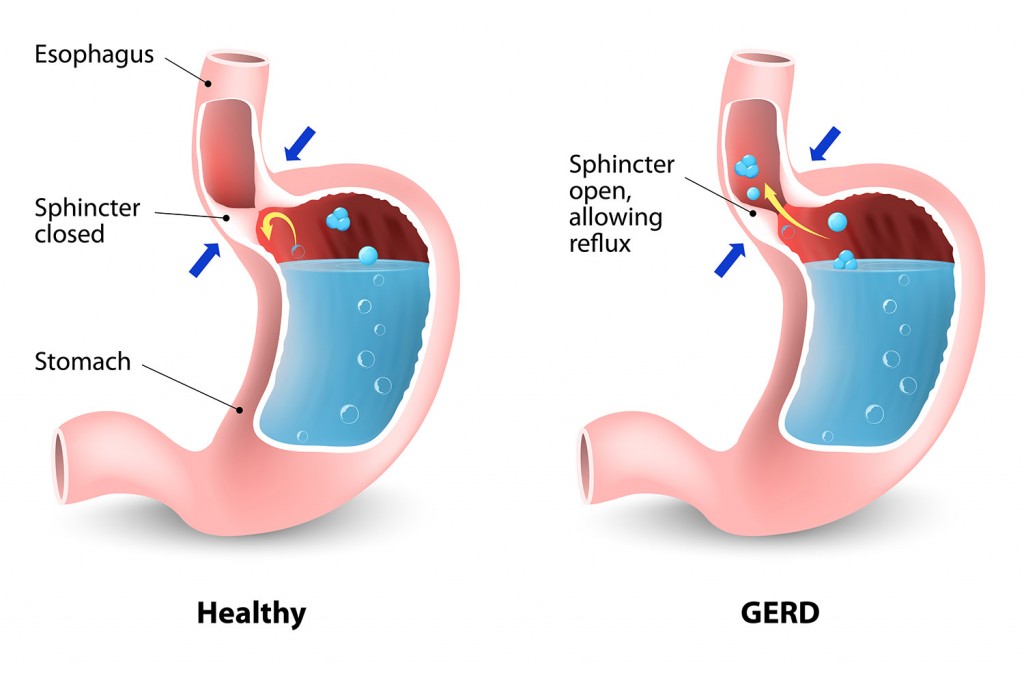 Gastroesophageal Reflux Disease Treatments | Gastro Health