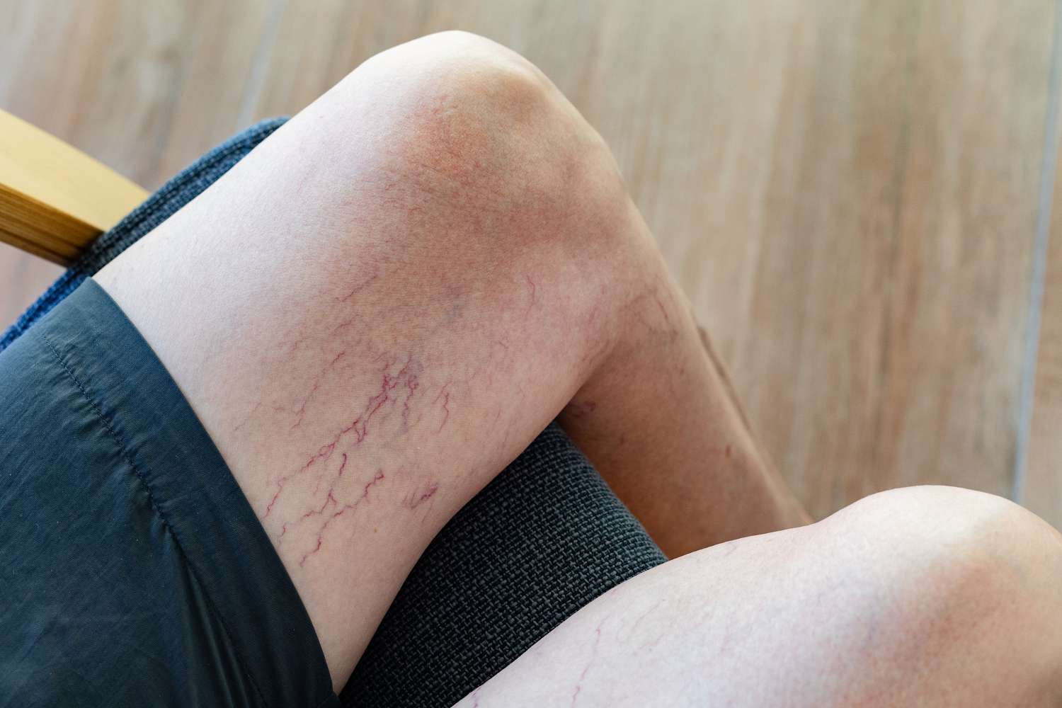 Telangiectasia: Causes, Symptoms, and Treatment
