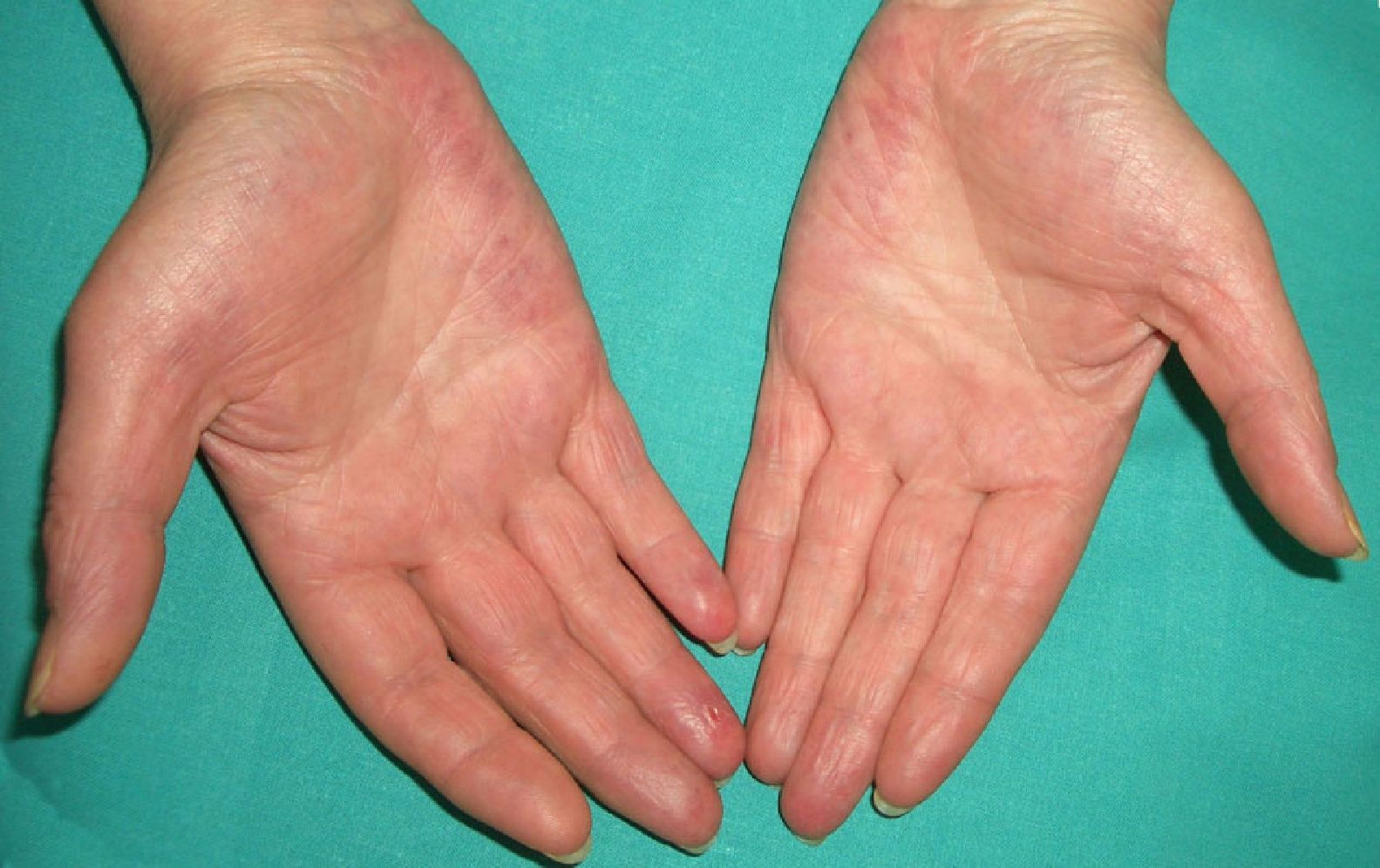 Cutaneous Alerts in Systemic Malignancy: Part I | Actas Dermo-Sifiliográficas