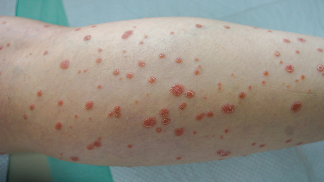 Guttate psoriasis: Causes, symptoms, and treatment