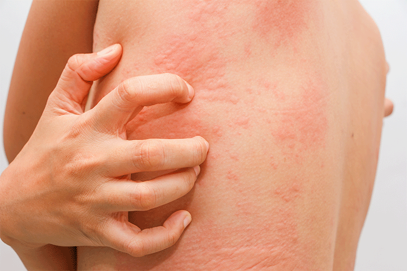 How Do I Get Rid Of A Skin Allergic Reaction Fast?