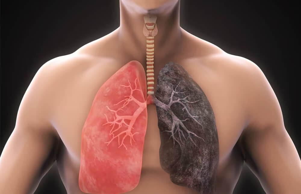Chronic obstructive pulmonary disease (COPD): causes, diagnosis and treatment in the best clinics