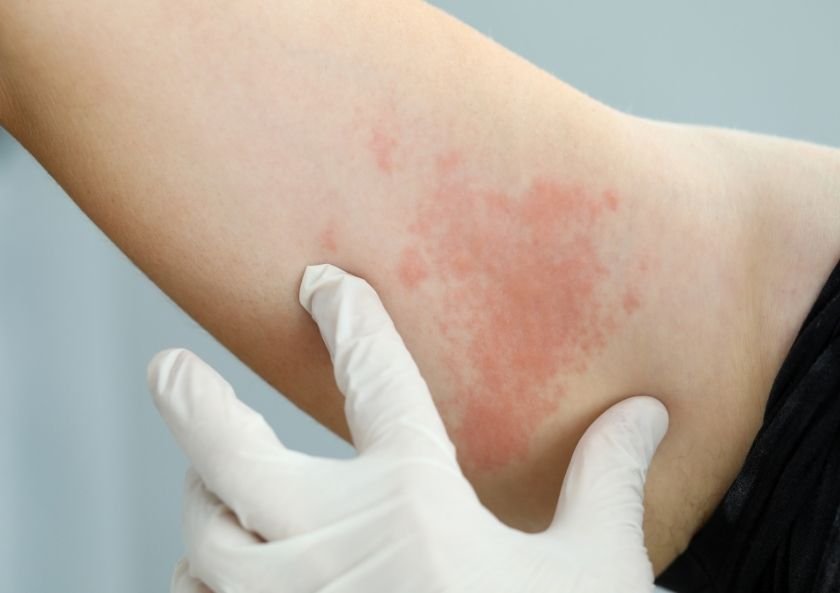 How is hives (urticaria) treated? – Istanbul Allergy