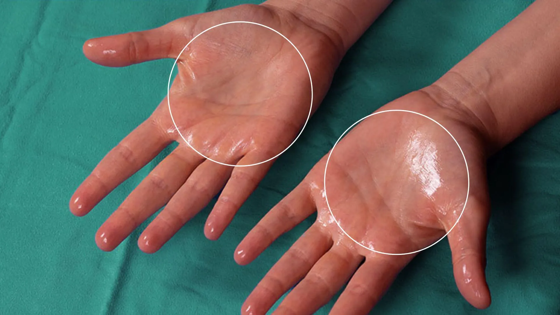 Hyperhidrosis Treatment | Award-winning Aesthetics Clinic Swindon