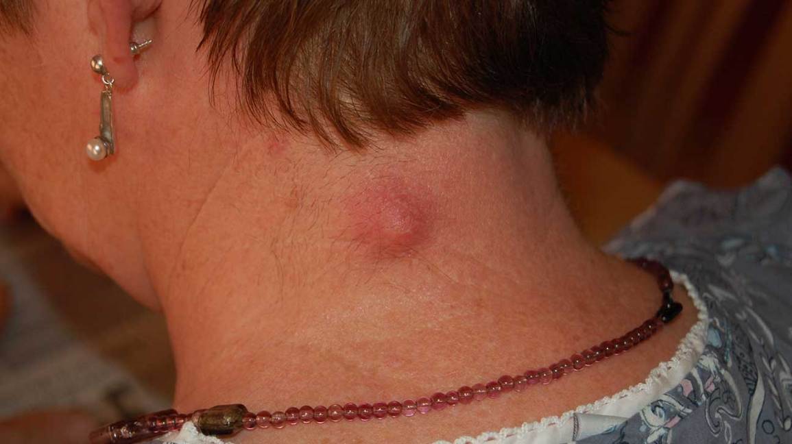 Cyst: Pictures, Causes, Types, Treatments, and Prevention
