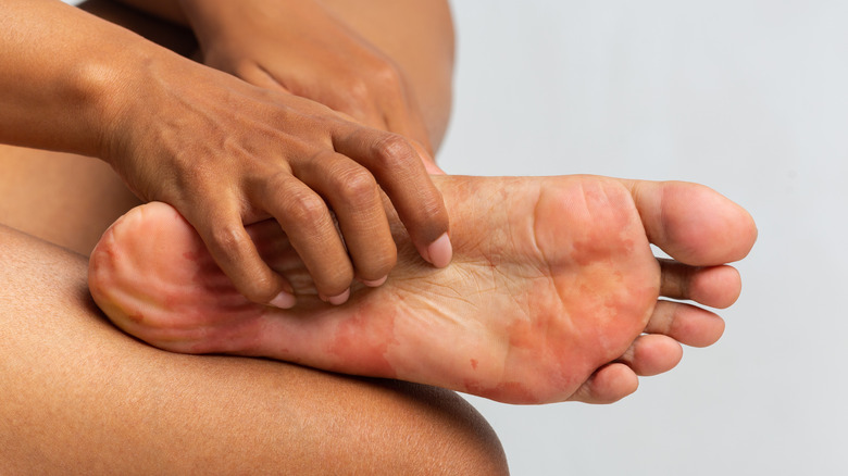 Things That Are Making Your Athlete's Foot Worse
