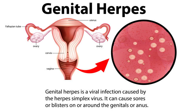 30+ Genital Herpes Stock Illustrations, Royalty-Free Vector Graphics & Clip  Art - iStock