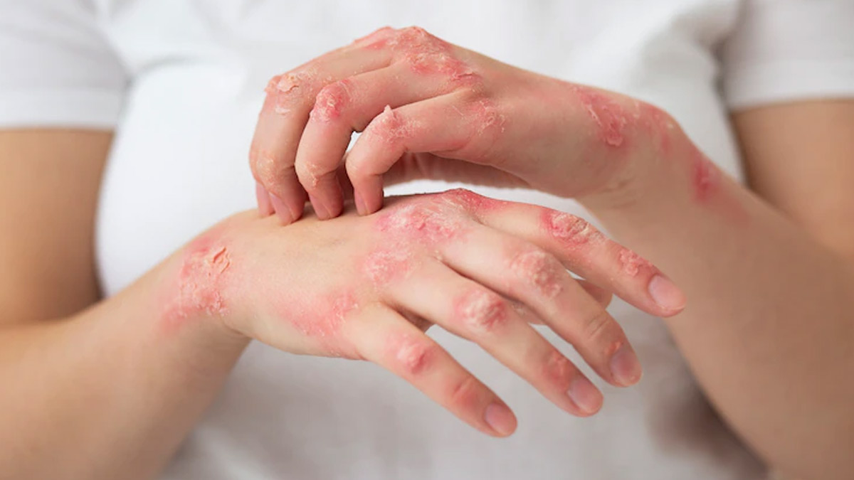 Symptoms, Complications, And Treatment For Psoriasis | OnlyMyHealth
