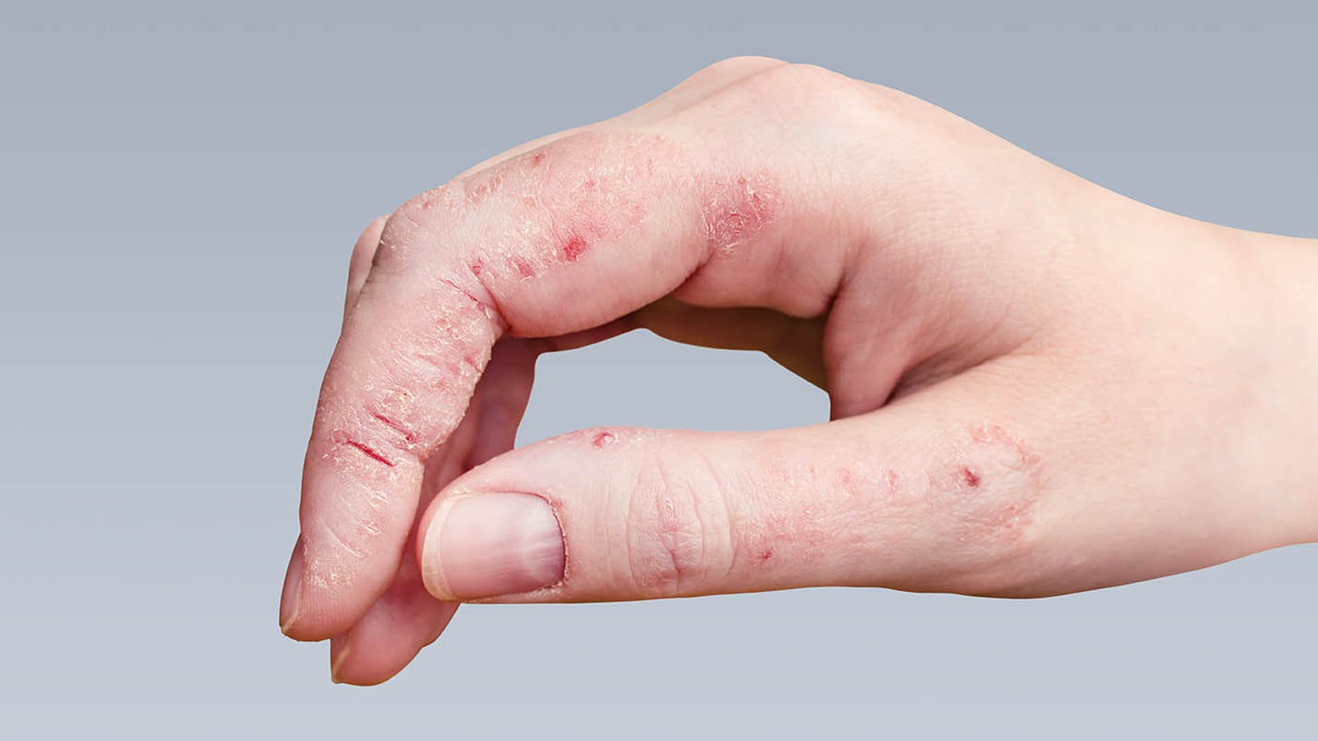 Fungal Infection