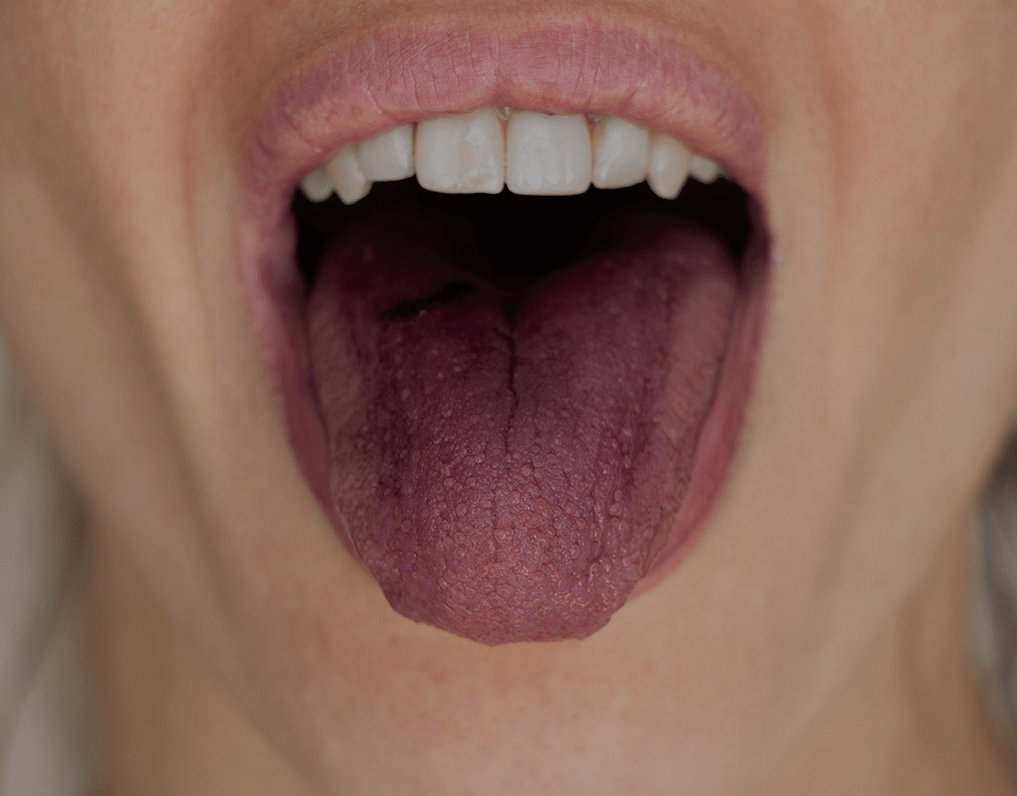 Purple Tongue: Causes And Treatment Options – NatruSmile