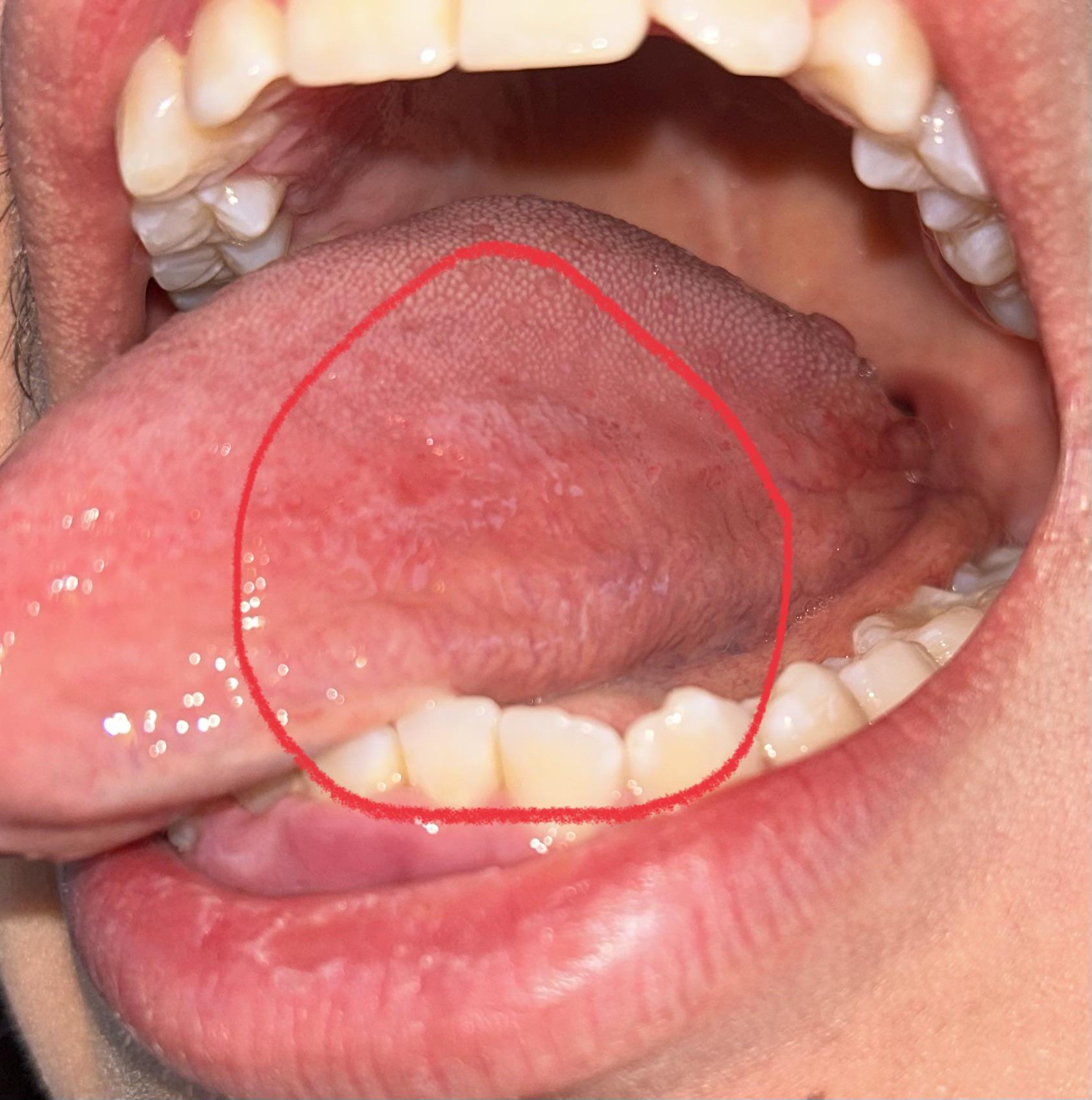 What is this stuff in my tongue?? : r/DentalHygiene