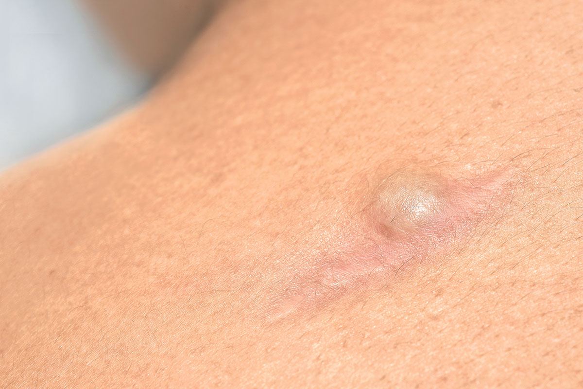 Epidermal (Sebaceous) or Skin Cyst Removal in Singapore - Lumine Dermatology & Laser Clinic