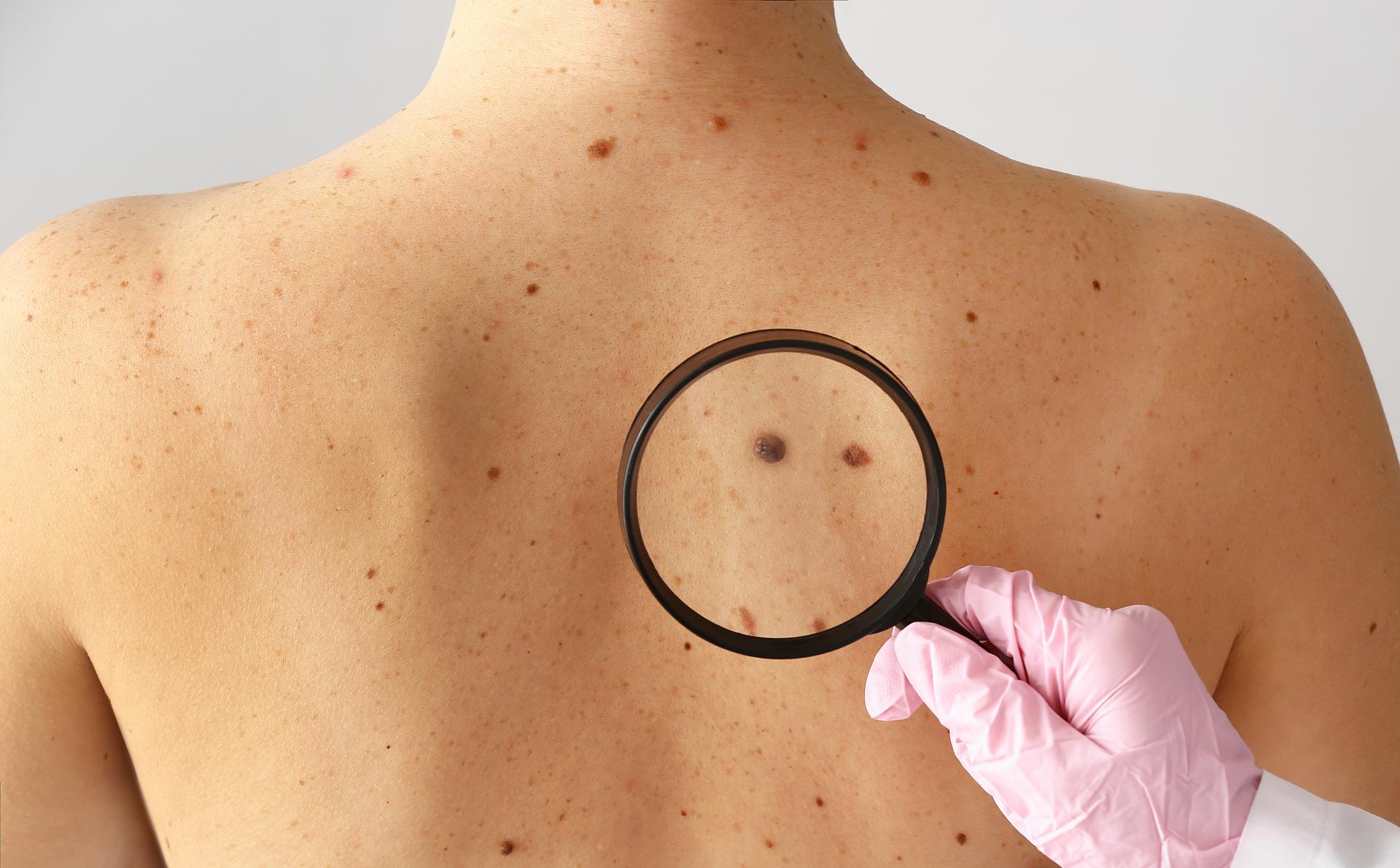 Skin Cancer Prevention & Treatment | Duncan Dermatology