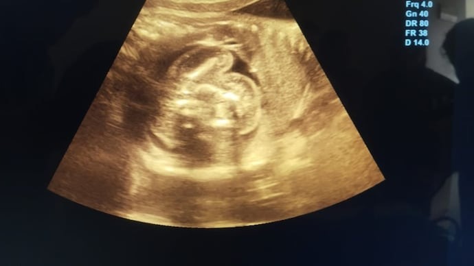 the-fetus-in-fetu-condition-is-b-3