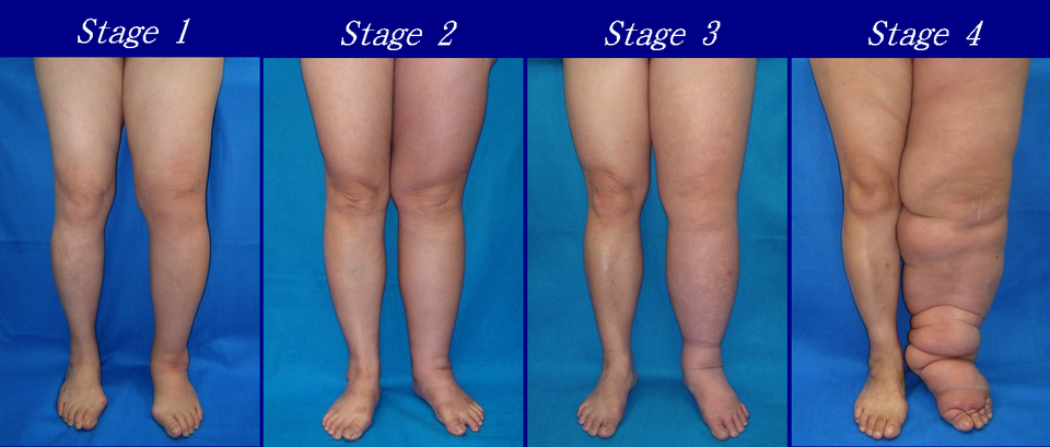 Lymphedema - Wikipedia