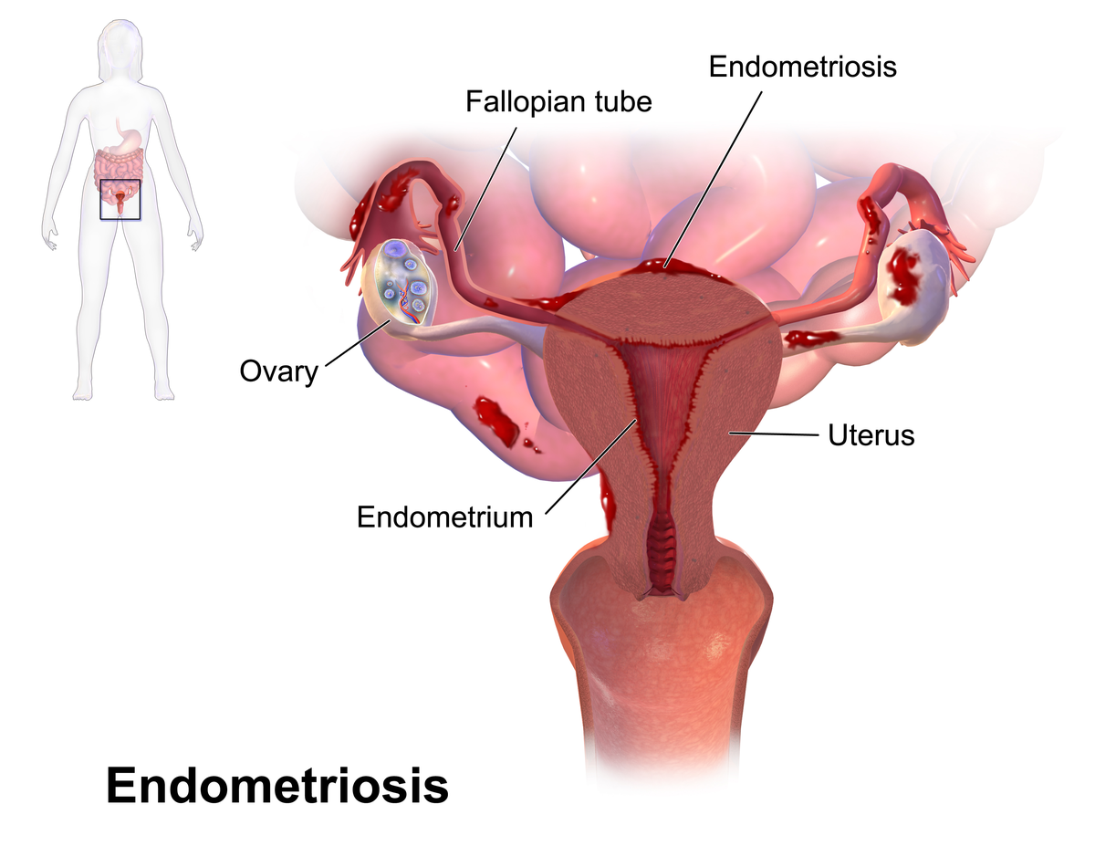 utf-8-2 Endometriosis - Wikipedia