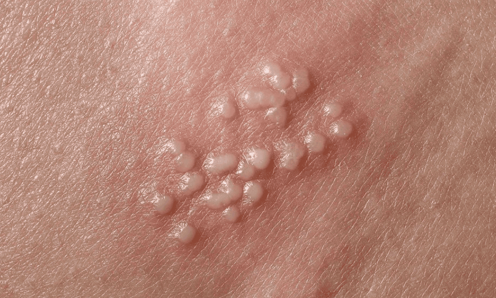 Vaginal Lumps, Bumps And Blisters – 9 Causes To Look Out For - EZRA Clinic
