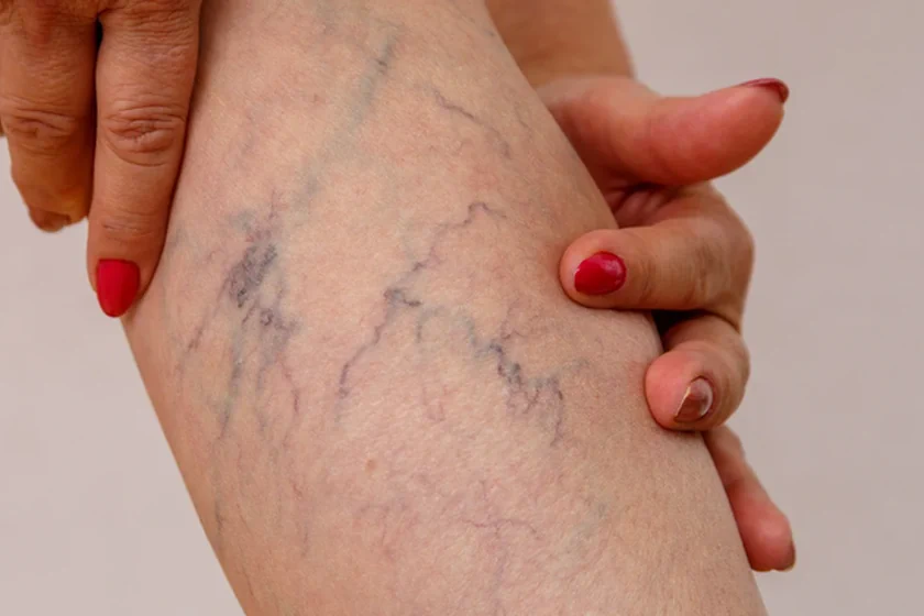Why Are My Veins So Visible All of a Sudden? - A Guide