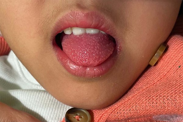 Scarlet fever - NHS
