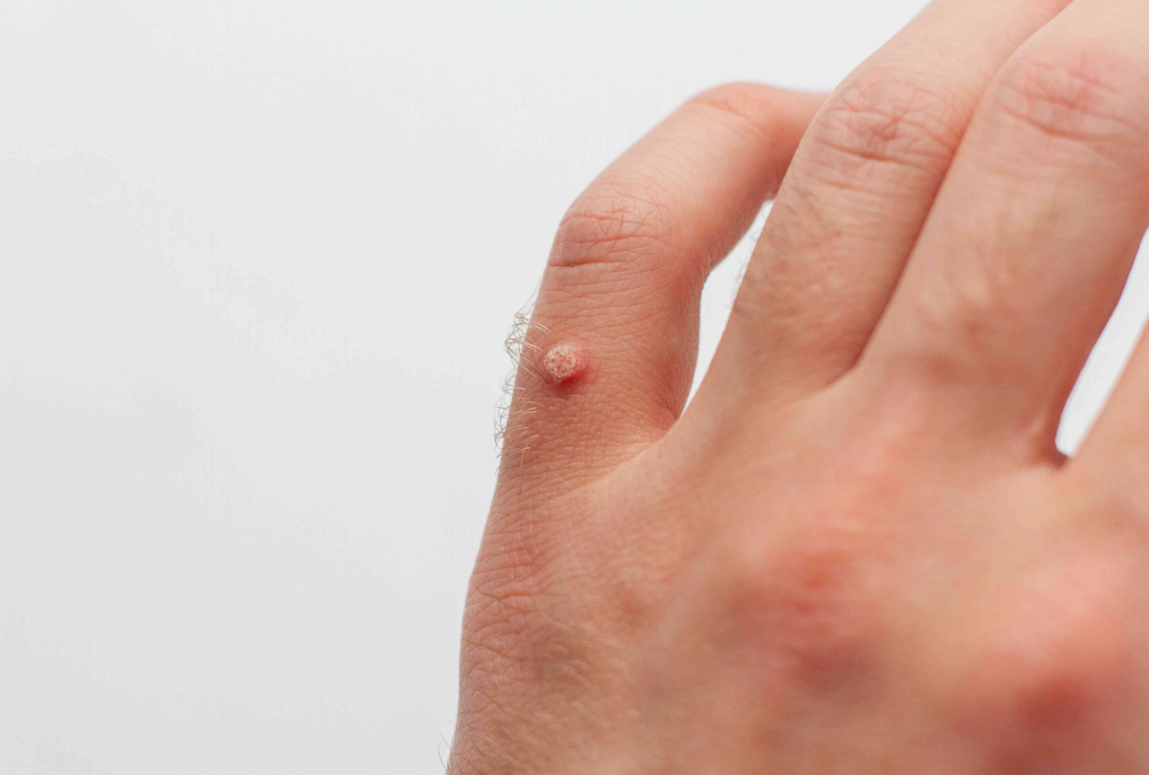 Human Papillomavirus (HPV) Infection: Symptoms and Prevention