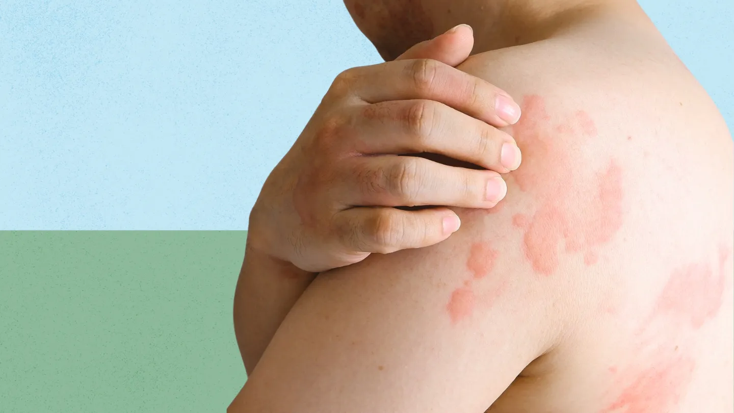 What Is Chronic Idiopathic Urticaria (Hives)? Symptoms, Causes, Diagnosis, Treatment, and Prevention
