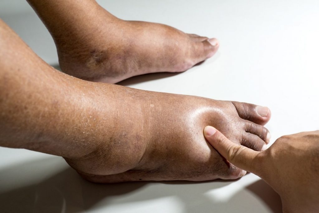 Lower Extremity Edema – Causes, Treatment, and Prevention